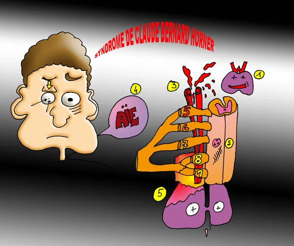 syndrome de claude bernard horner — dessin MEDESSINE de Yoan Mboussou
